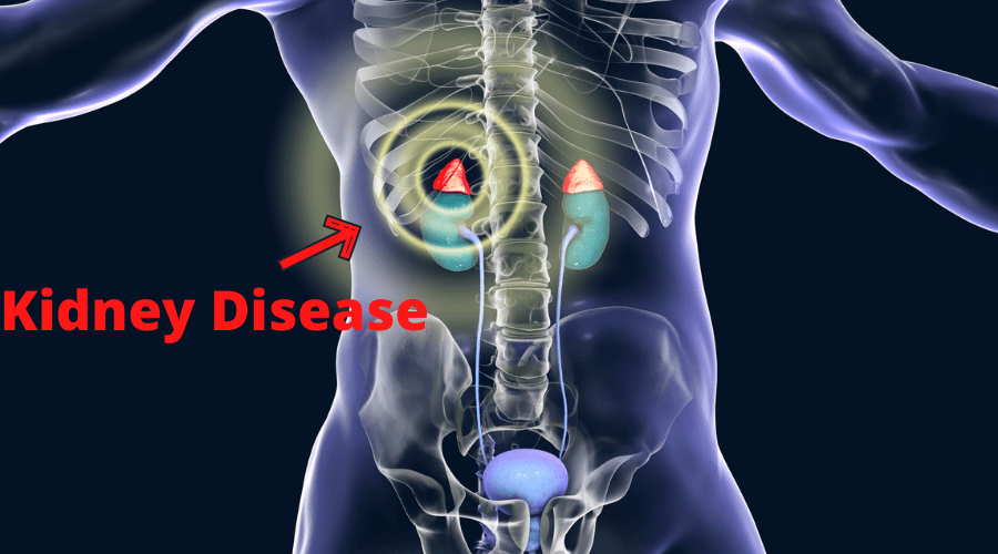 Kidney Disease 2 -
